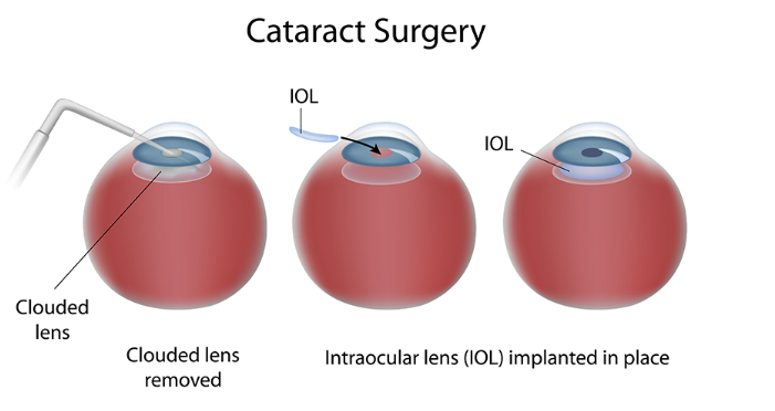 Cataract Surgery