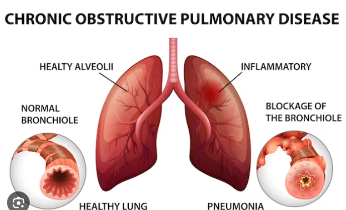 COPD