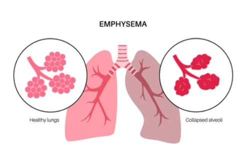 Emphysema