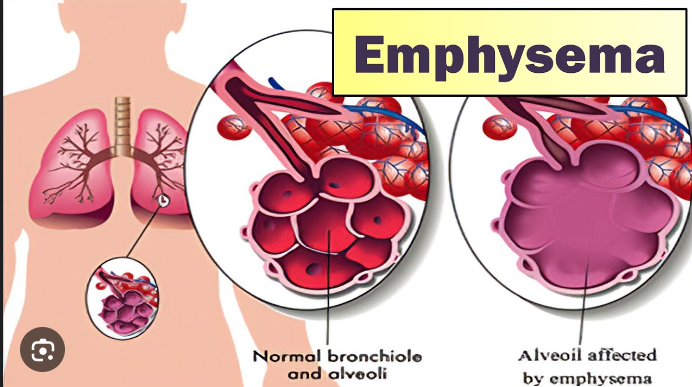 Emphysema