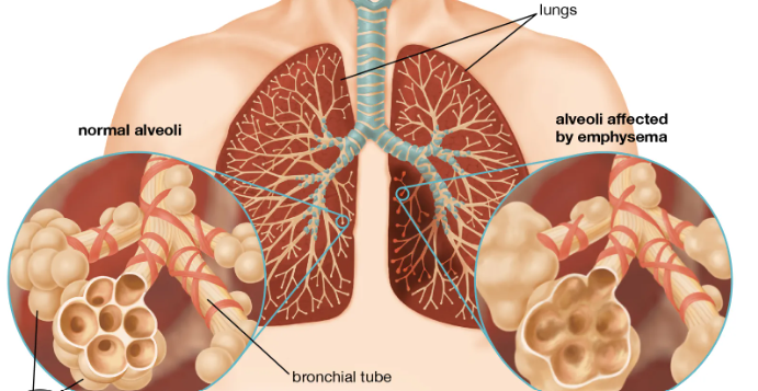 Emphysema