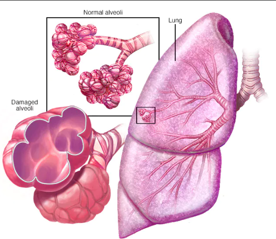 Emphysema