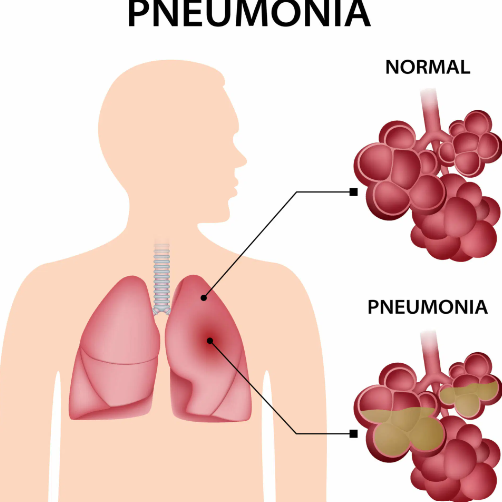 Pneumonia