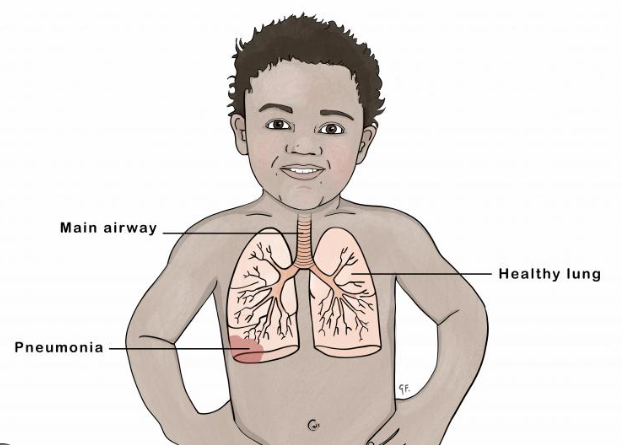 Pneumonia