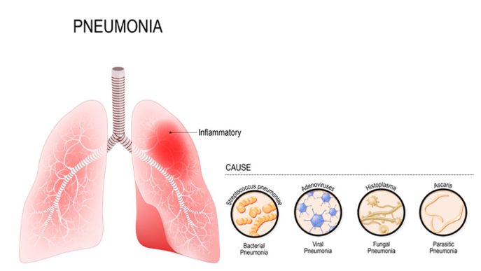 Pneumonia