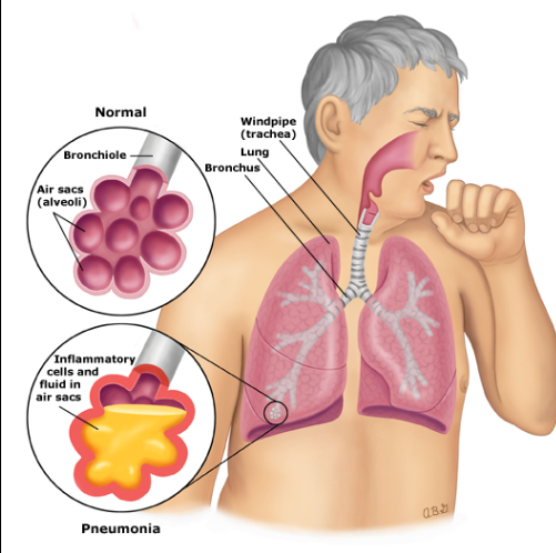 Walking Pneumonia 