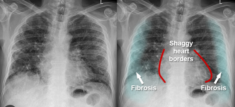 Pulmonary Fibrosis