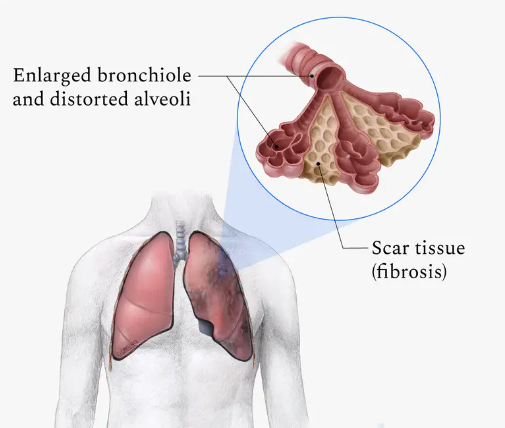 Pulmonary Fibrosis