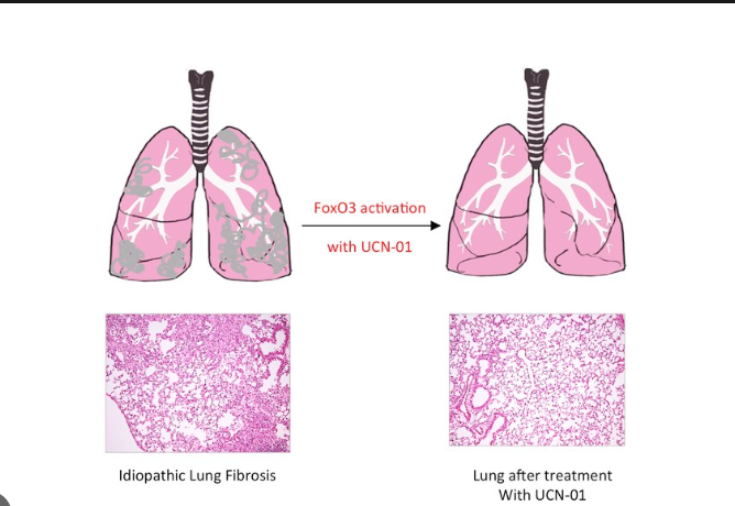 Pulmonary Fibrosis