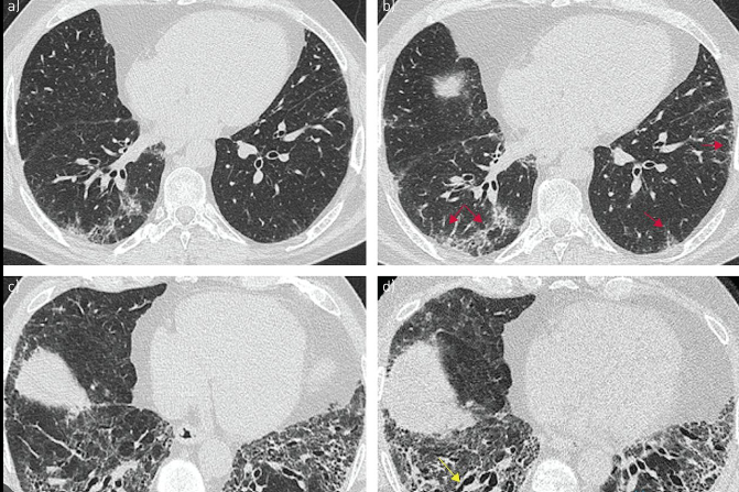 Pulmonary Fibrosis