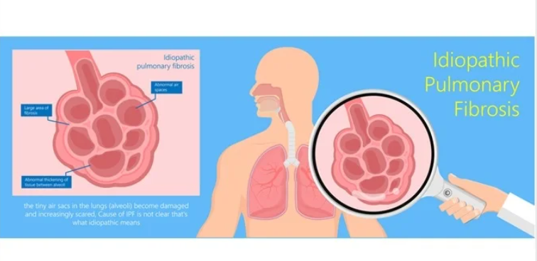 Pulmonary Fibrosis