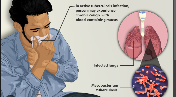 Tuberculosis