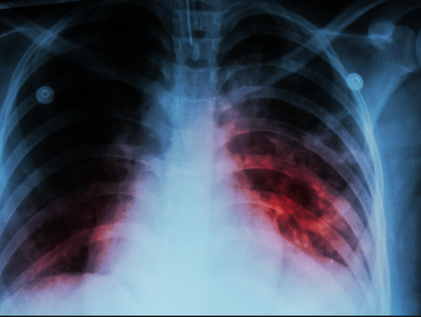 Tuberculosis