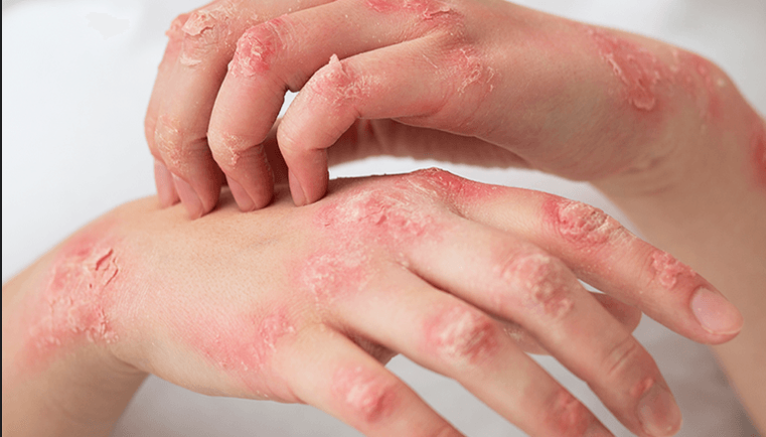 Eczema