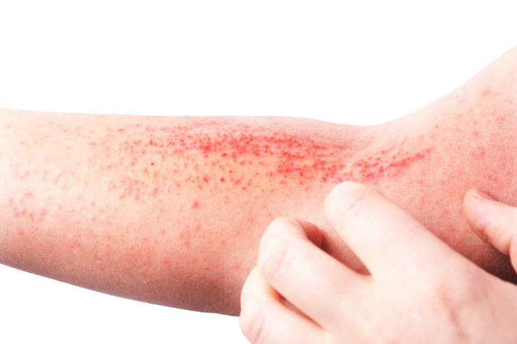 Eczema