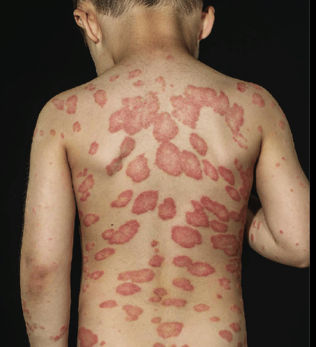 Plaque Psoriasis