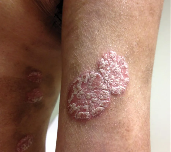 Plaque Psoriasis