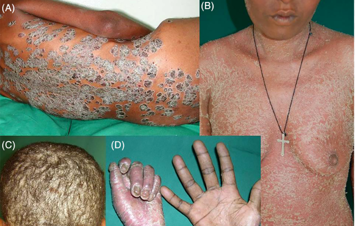 Plaque Psoriasis