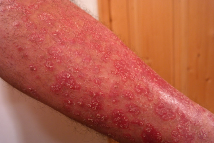 Plaque Psoriasis