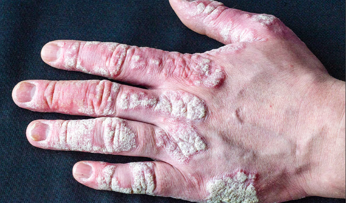 Plaque Psoriasis