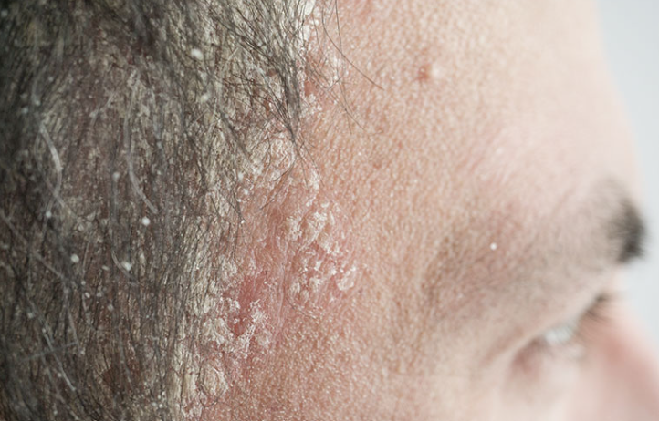 Scalp Psoriasis