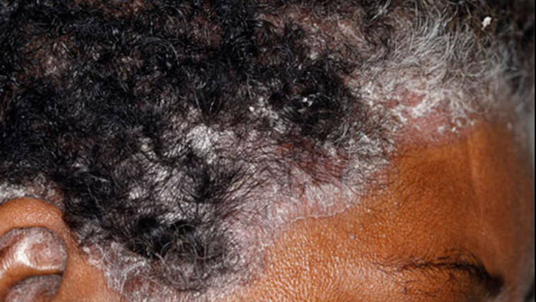 Scalp Psoriasis