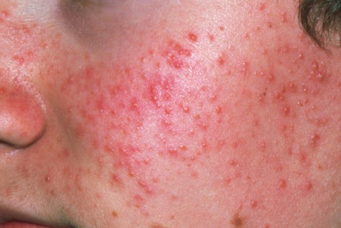 Skin Diseases