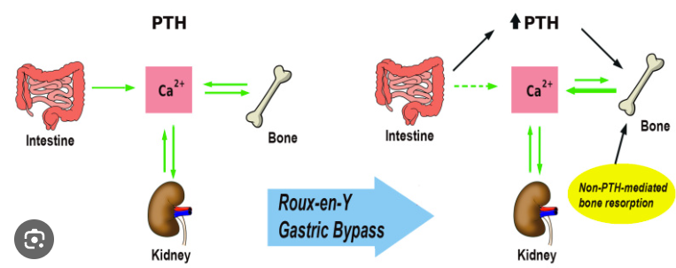 Bariatric Surgery