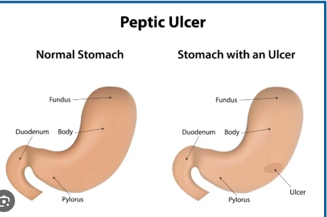 Peptic Ulcers