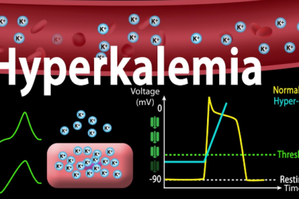 Hyperkalemia