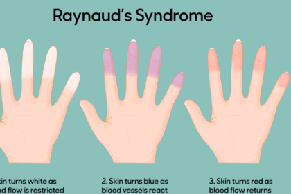 Raynaud's Syndrome