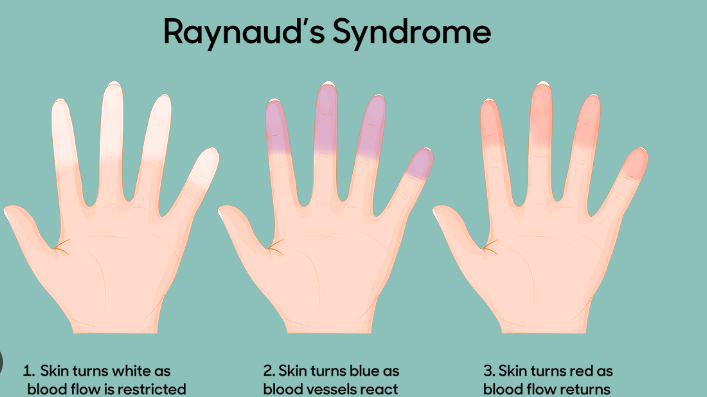 Raynaud's Syndrome