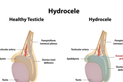 Filarial Hydrocele