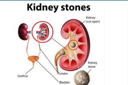 Kidney Stones