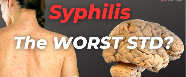 Syphilis