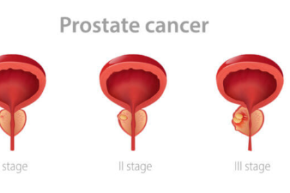 prostate cancer