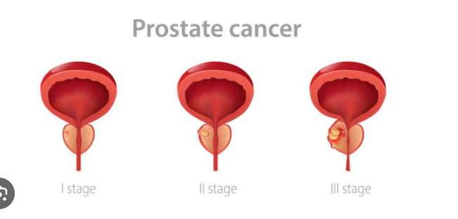 prostate cancer