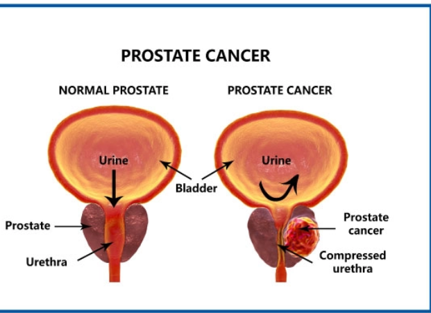 Prostate Cancer 