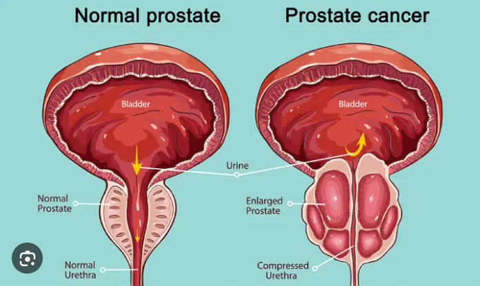 Prostate Cancer 