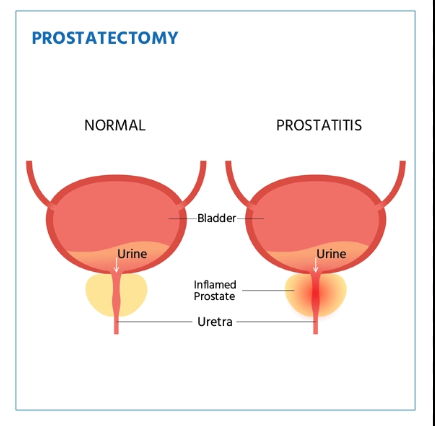 Prostate Cancer 