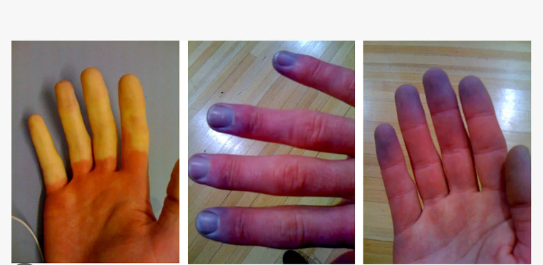 Raynaud's Syndrome