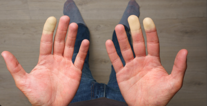 Raynaud's Syndrome