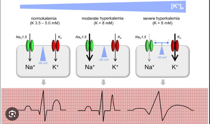 Hyperkalemia