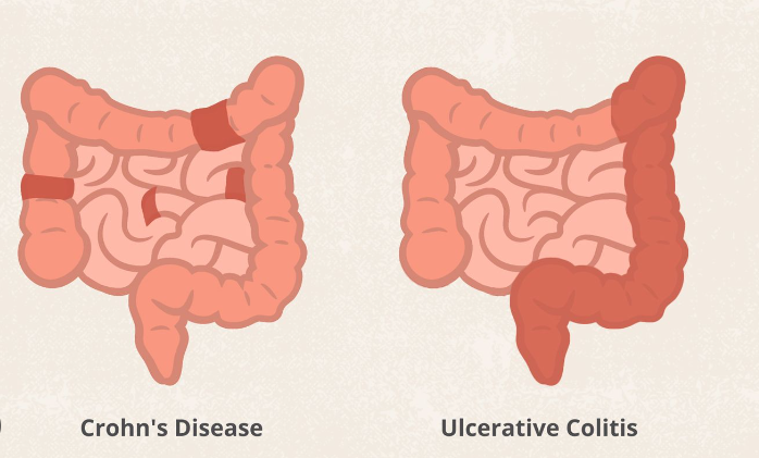 Crohn's Disease