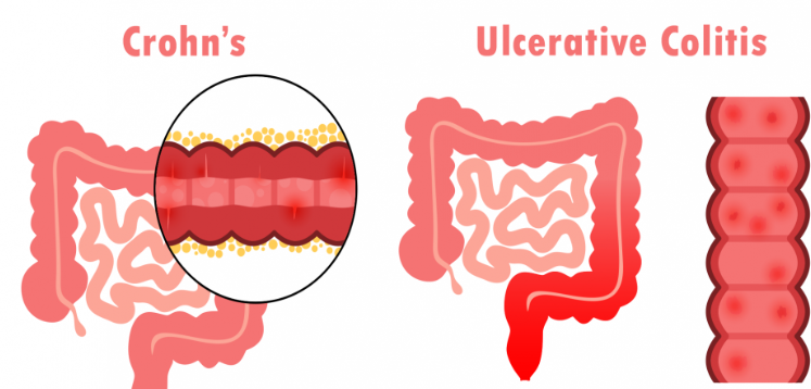 Crohn's Disease