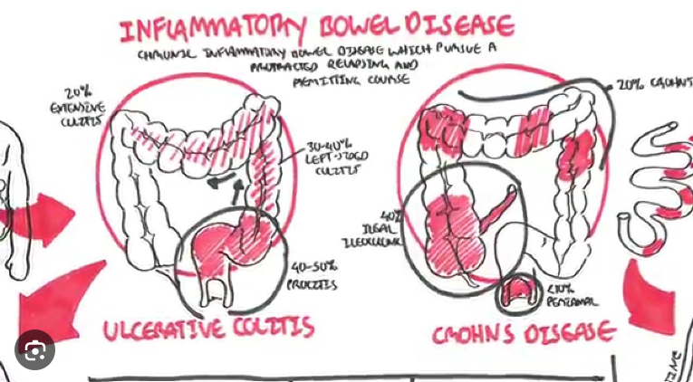 Crohn's Disease