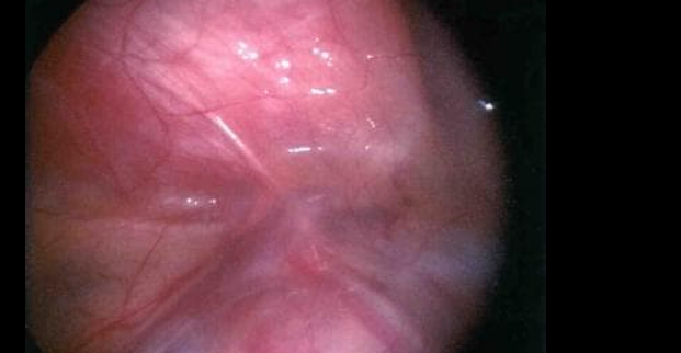 Filarial Hydrocele