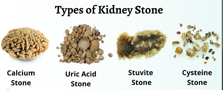 Kidney Stones