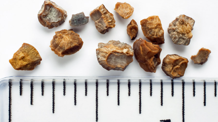 Kidney Stones