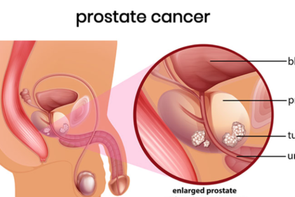 Prostate Cancer